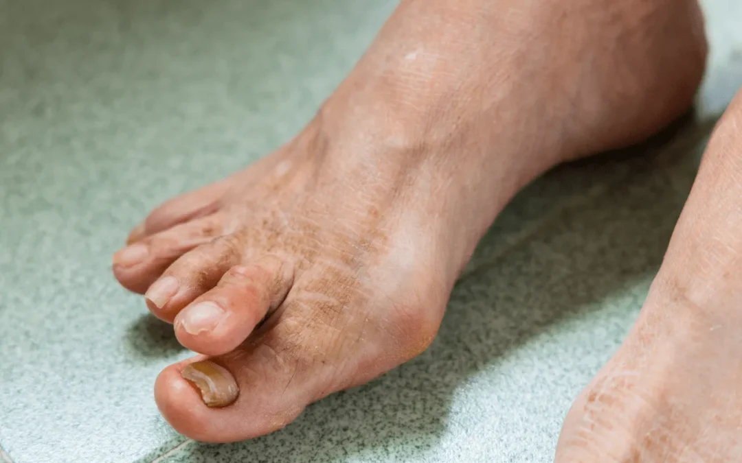 Soulager l&rsquo;hallux valgus avec des remèdes de grand-mère