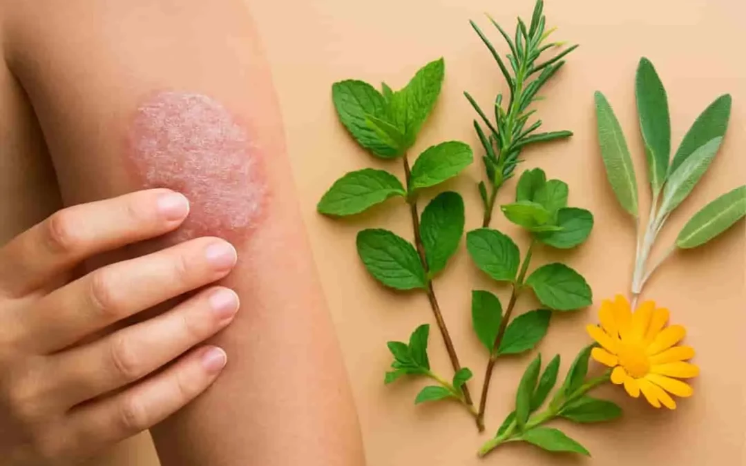 Traiter le psoriasis par les plantes : guide complet des remèdes naturels