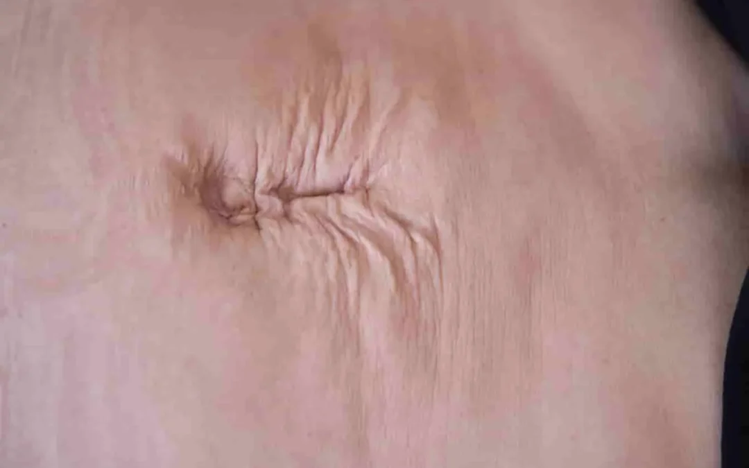 Diastase abdominale (Diastasis Recti) : comprendre l&rsquo;écartement des grands droits, causes et solutions