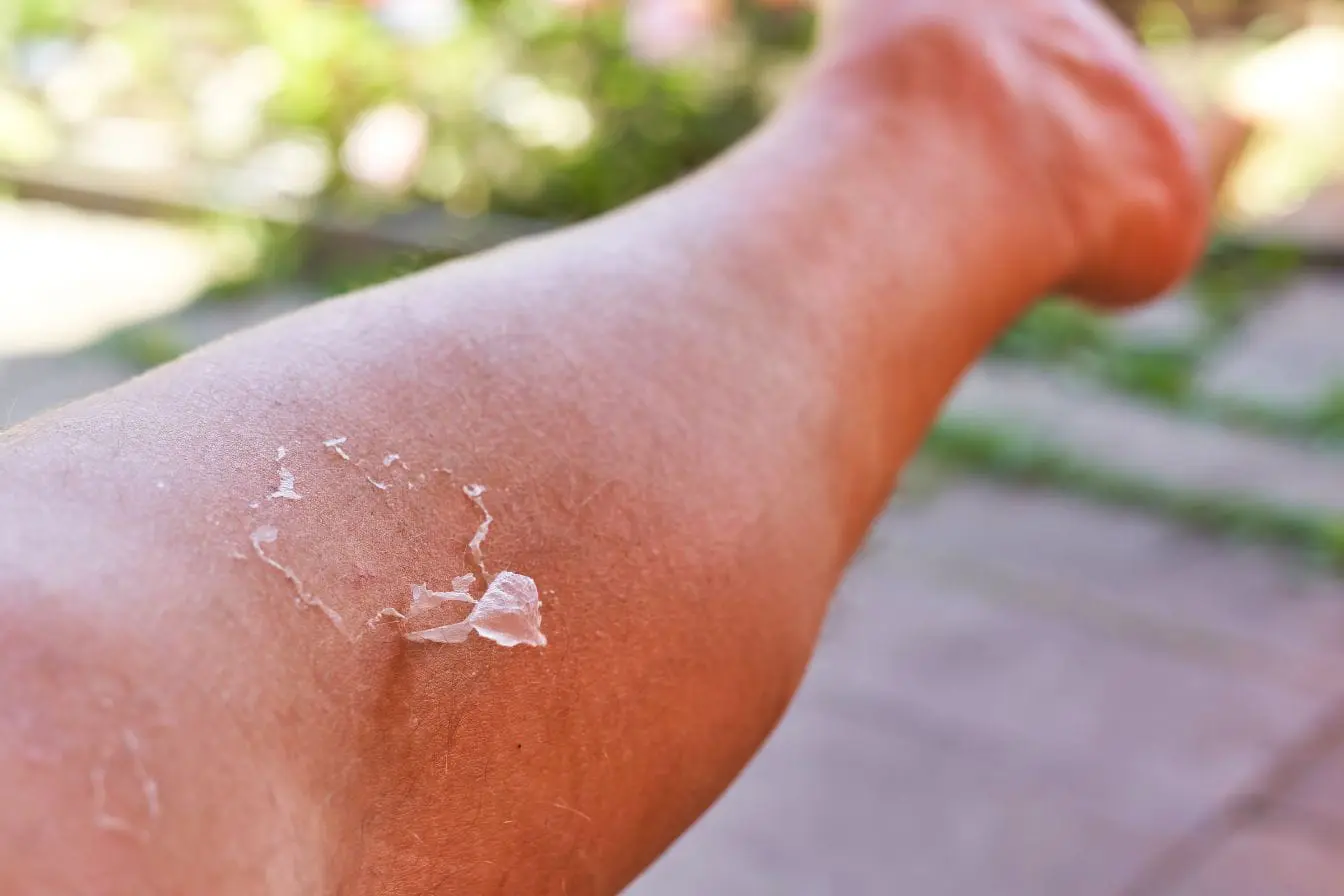 peau qui pèle Gros plan sur avant-bras humain avec zones rouges et peau qui pèle