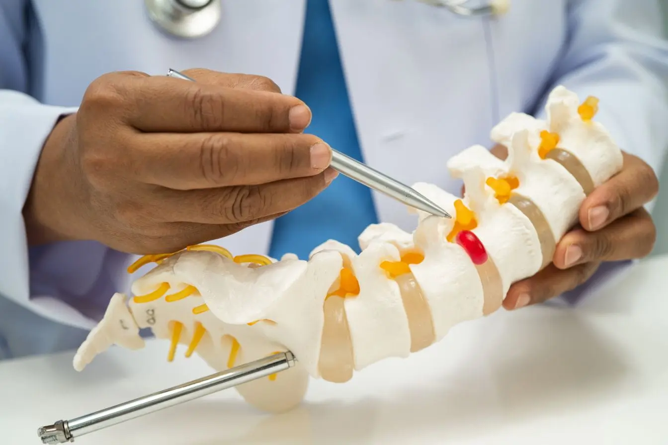 Médecin en blouse blanche tenant modèle de colonne vertébrale avec disque rouge illustrant la discopathie dégénérative lombaire et ses impacts