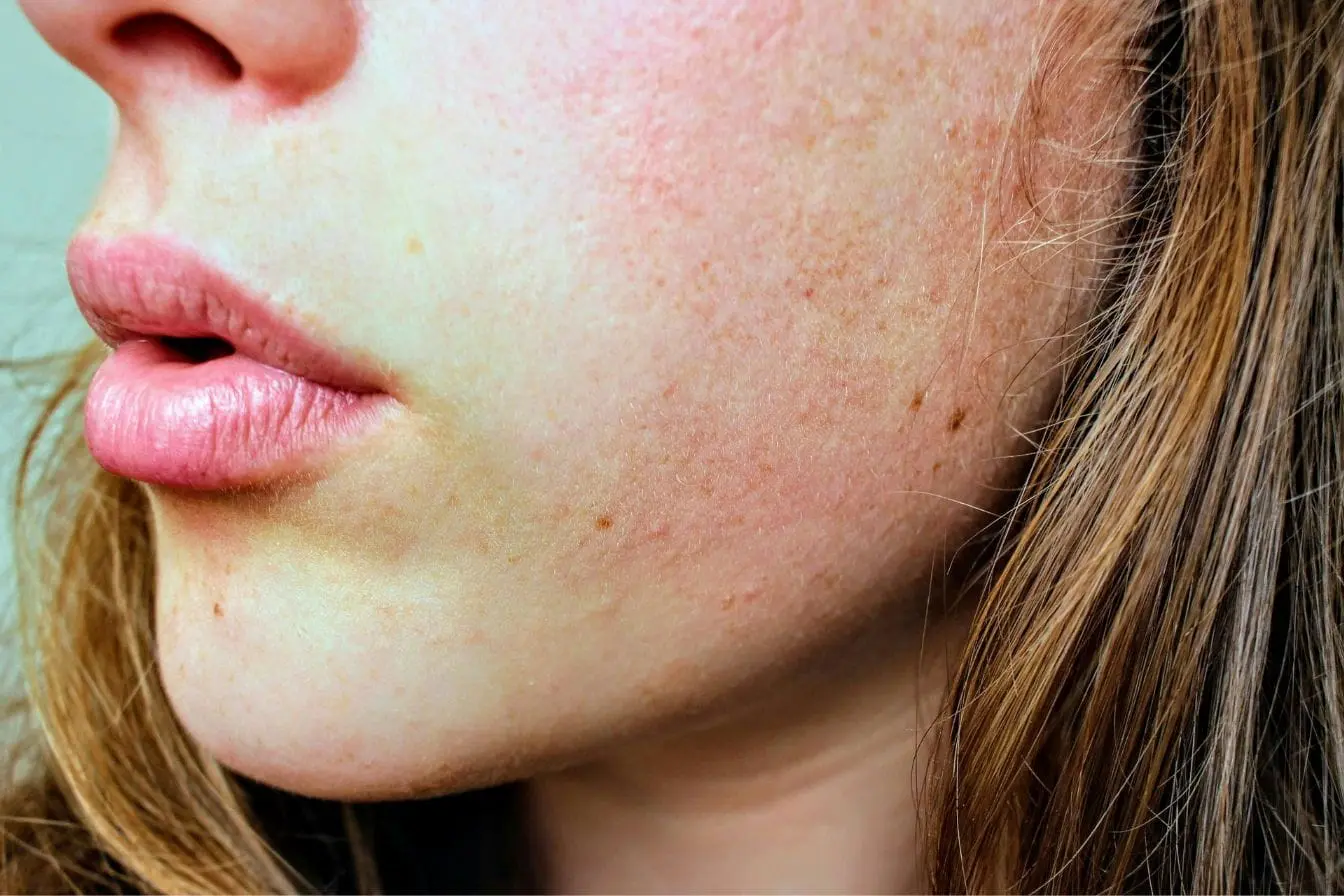 Gros plan sur visage avec rougeurs et pores visibles, image illustrant les signes cutanés fréquents de l’allergie au gluten chez l’adulte.