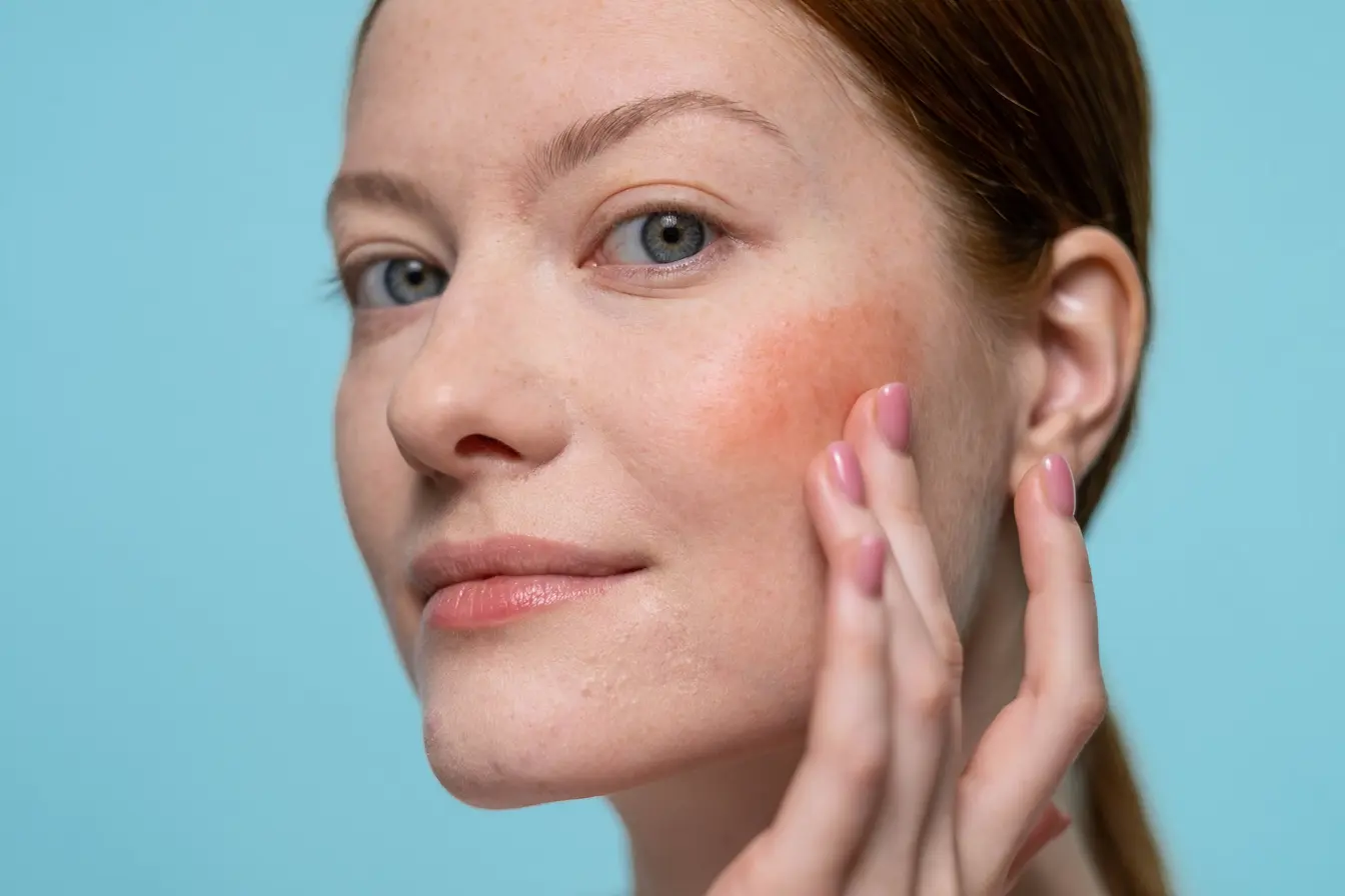 Gros plan sur visage avec rougeurs légères sur joue, symbole des effets de la rosacée et de l’importance de l’alimentation pour limiter les poussées.