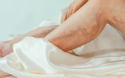 Varices : quels remèdes naturels pour soulager les jambes lourdes et douloureuses ?